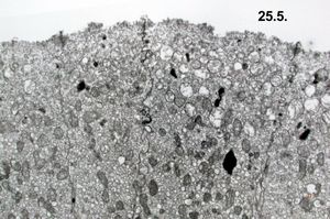 jejunum - celiakia jejunum - celiakia